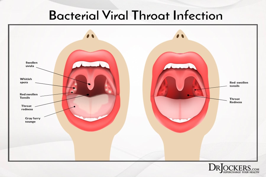 Causes of a Sore Throat - Vocalzone.