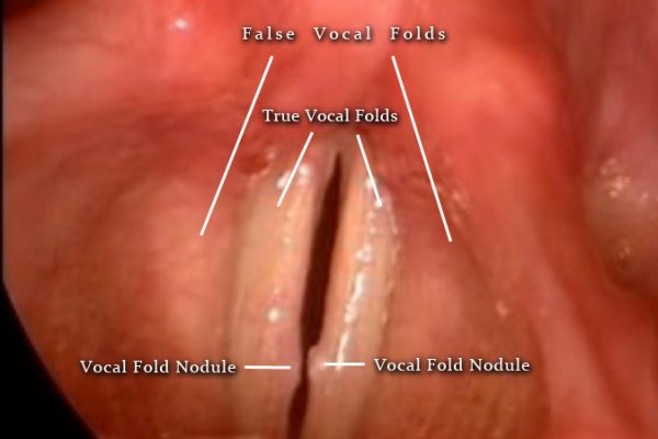 Vocal-Folds-Avoid-Vocal-Burnout